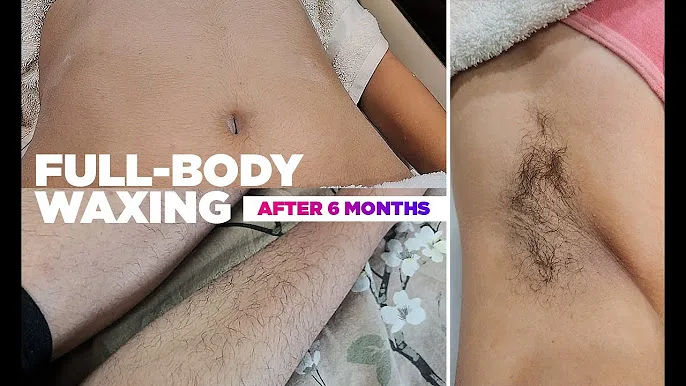 Full Brazilian Laser Hair Removal before And After Photos